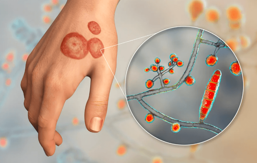 Home Remedies For Ringworm Treatment And Ringworm Disease